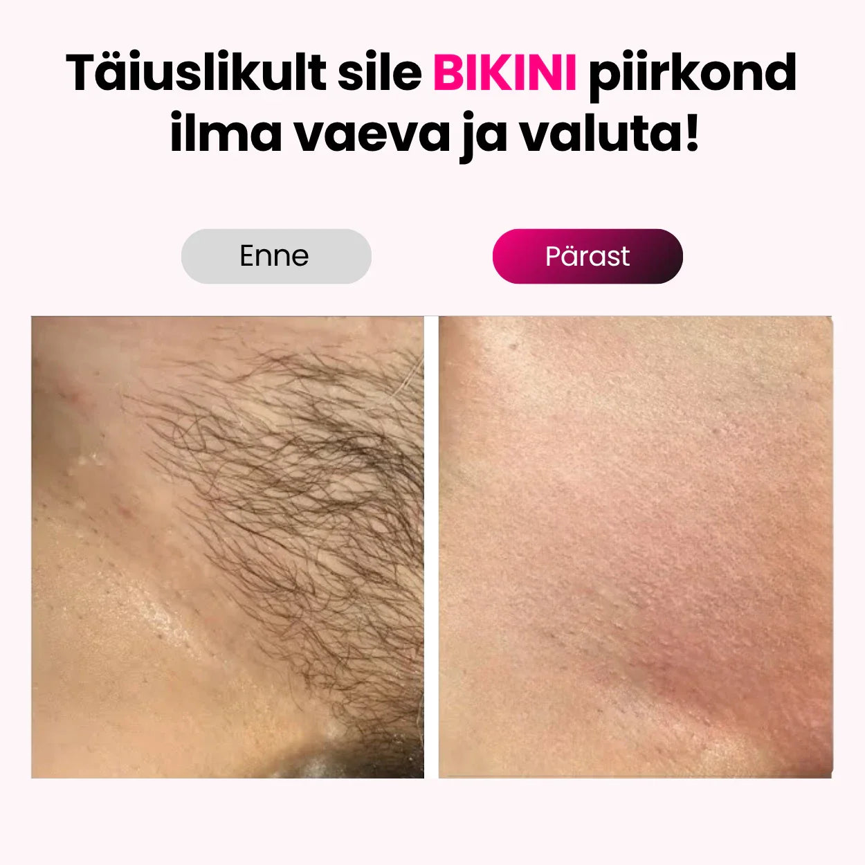 Elumi™ IPL-fotoepilaatori komplekt